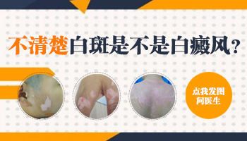 手部有几片白斑是不是白癜风