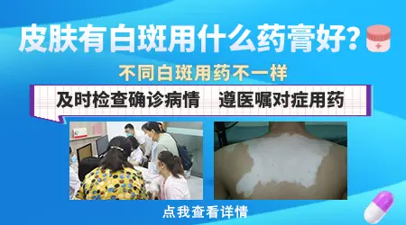 治疗白癜风的外用药物有哪些 哪种效果最好