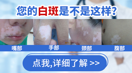 伍德灯检查白点会不会误诊 白点是不是白癜风做哪些检查