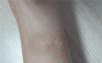 宝宝胳膊上有一块白是怎么回事