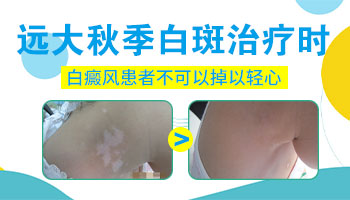 白癜风扎火针为什么越来越严重