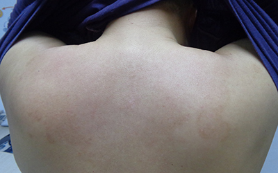 背部有白癜风好治吗用什么方法治