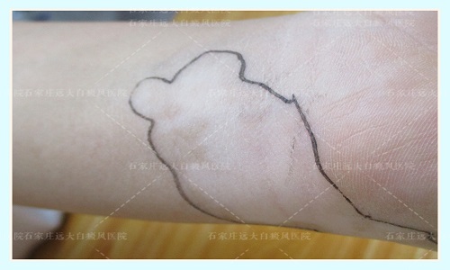 白癜风是啥样子