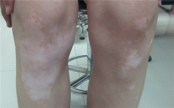 孩子每个腿上都有几个白块是怎么了