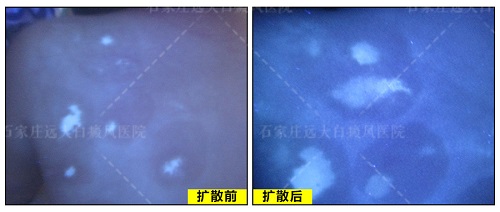 wood灯下白点点显示有白色荧光说明是白癜风吗