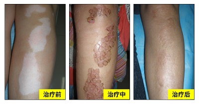 白癜风好几年了基本上没发展怎么治