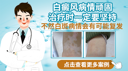 白癜风照什么光恢复的比较快