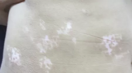 后腰有一块发白不是很明显是不是白癜风