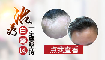 对称性白癜风好治吗