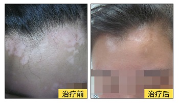 眼角下边皮肤发白有什么治疗的方法吗