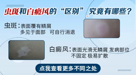 儿童虫斑和白癜风的区别