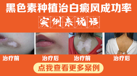 面部表皮移植治疗白癜风需要多长时间