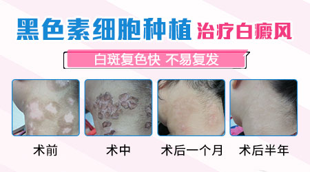 种植黑色素治疗白斑多少钱