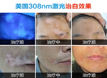 308激光治疗白癜风需要多少钱