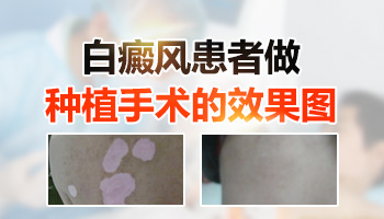 哪些情况白癜风不能做种植