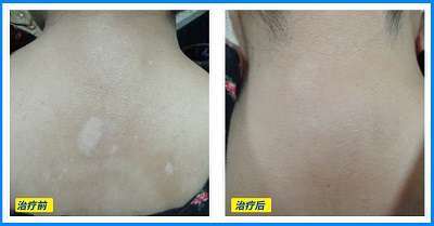 初期白斑治疗费高吗 白癜风怎么治疗好