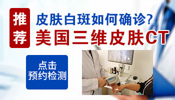 白斑照灯发蓝是白癜风吗