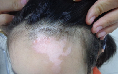 额头上起白斑的图片 额头白斑怎么治