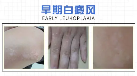 儿童脸上长白点 白癜风图片