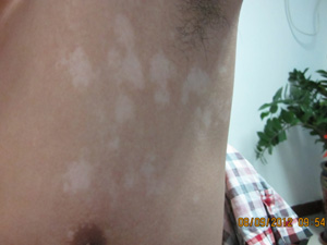 身上好多小白点图片 白点能不能治好