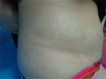 女士身上出现光滑的白斑需要去医院检查吗