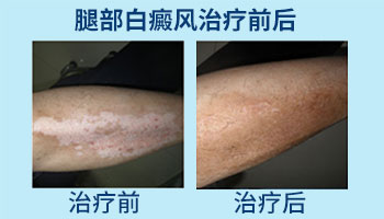 半岛308激光照白癜风效果怎么样