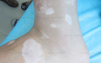 脚后跟出现很多白色点点