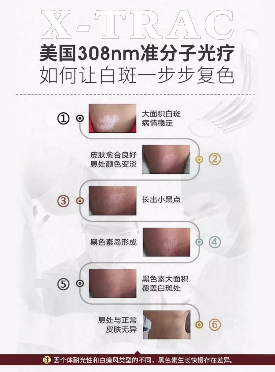 白癜风照光正常的话应该有什么反应