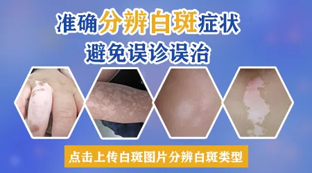 白癜风前期症状表现图片