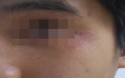 小孩缺维生素脸上白斑图片