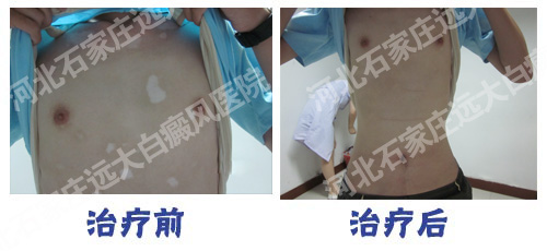 胸部下面一点出现光滑的白斑是不是白癜风