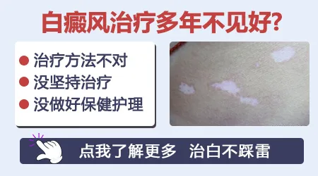 白癜风治疗两周没效果是不是治疗方法不对