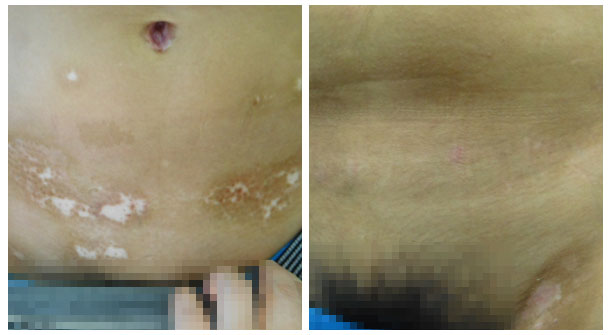 腰两侧白癜风一直在照光吃药治疗治不好