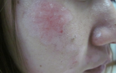 脸上长白斑的图片 如何判断白斑病症