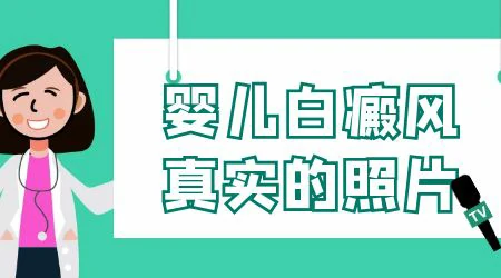婴儿白癜风初期图片大全