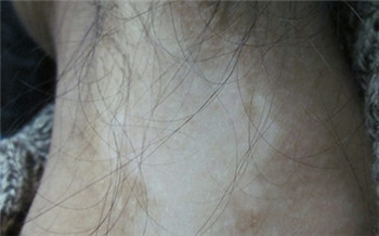 脖子上白了一块会变大吗