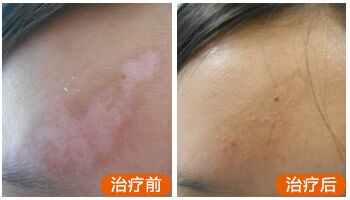 白癜风激光治疗仪多少钱