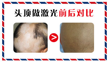 伍德灯检查白斑显示双加号是什么意思