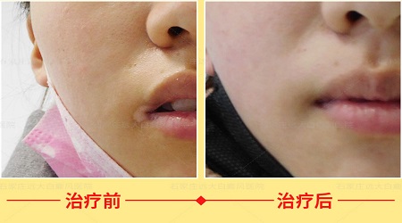 嘴角白癜风半年多了没扩散怎么治