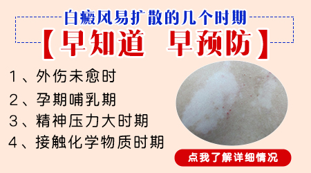 孕期白癜风有白癜风扩散的征兆