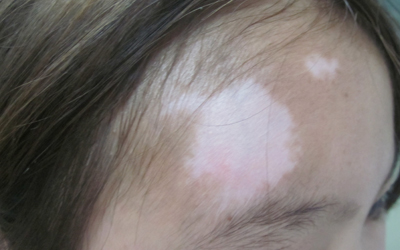 13岁小孩额头上有一块白的是什么原因