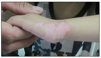 两岁宝宝手臂上有几个白斑