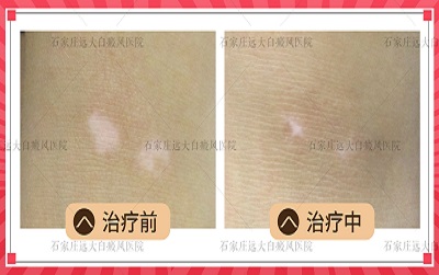 白癜风患者光疗后多久可以擦药膏