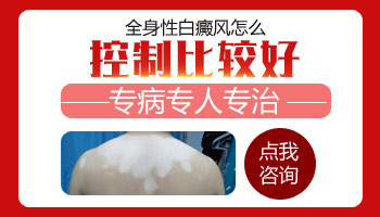 全身几乎都是白癜风吃药能控制吗