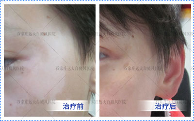 白癜风可以通过治疗恢复到原来皮肤的颜色吗