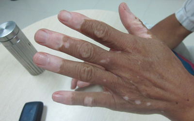 手指未端皮肤变白图片 皮肤变白原因是什么