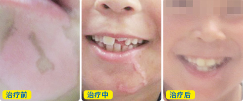 脸上的白斑用他克莫司软膏会复色吗