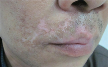 男性嘴部白癜风早期症状的图片