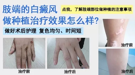 手部白癜风适合光疗还是黑色素移植手术