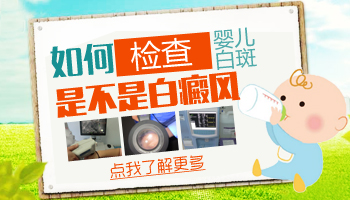 婴儿白斑图片和白癜风图片对比